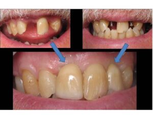 Benefits of Dental Implants in Milpitas