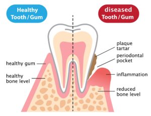 Periodontal Therapy in Milpitas