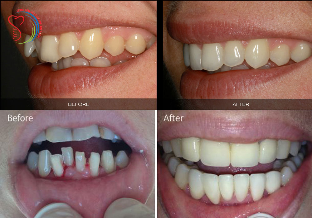 Benefits of Dental Crowns in Milpitas