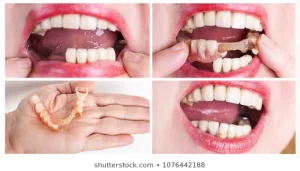 Benefits of full and partial dentures in Milpitas