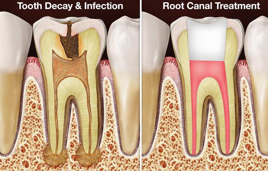 Benefits of Root Canal in Milpitas