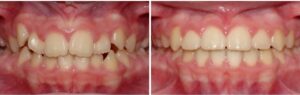 CROWDED TEETH AND OPTIONS TO SOLVE IT
