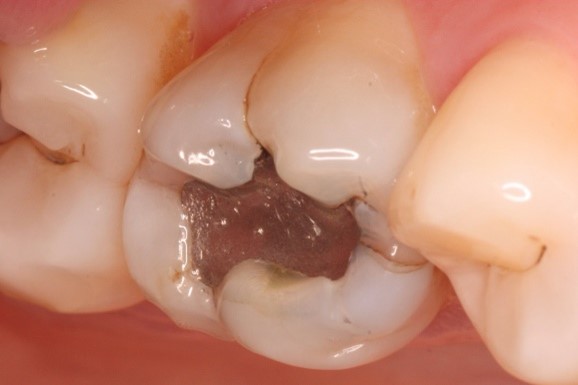 Fractured teeth or cracked tooth