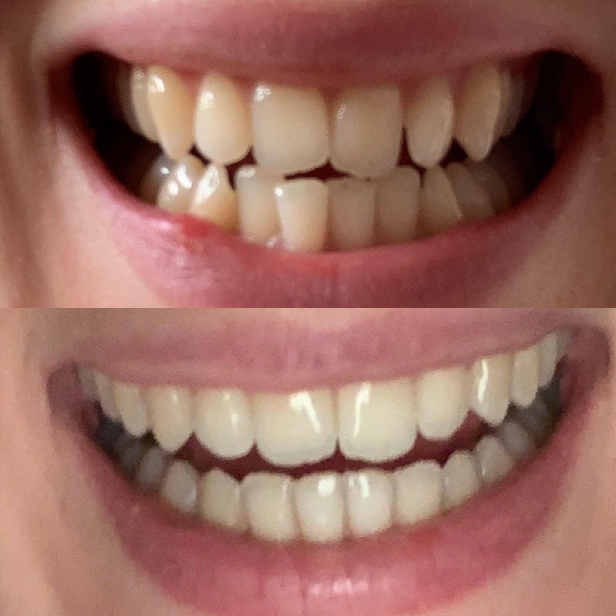 INVISALIGN vs. BRACES 1 DENTIST IN CALIFORNIA 95035