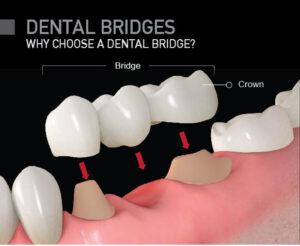 How to take care of dental bridges