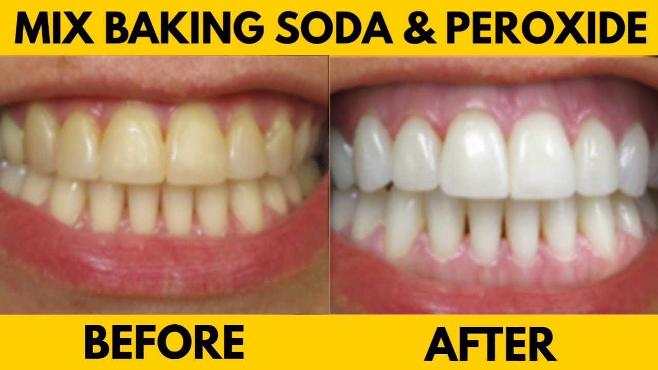 baking soda teeth before after