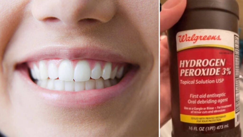 hydrogen peroxide baking soda teeth whitening before after