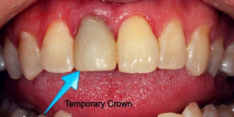 things-you-need-to-know-about-temporary-crowns-1-dentist-in