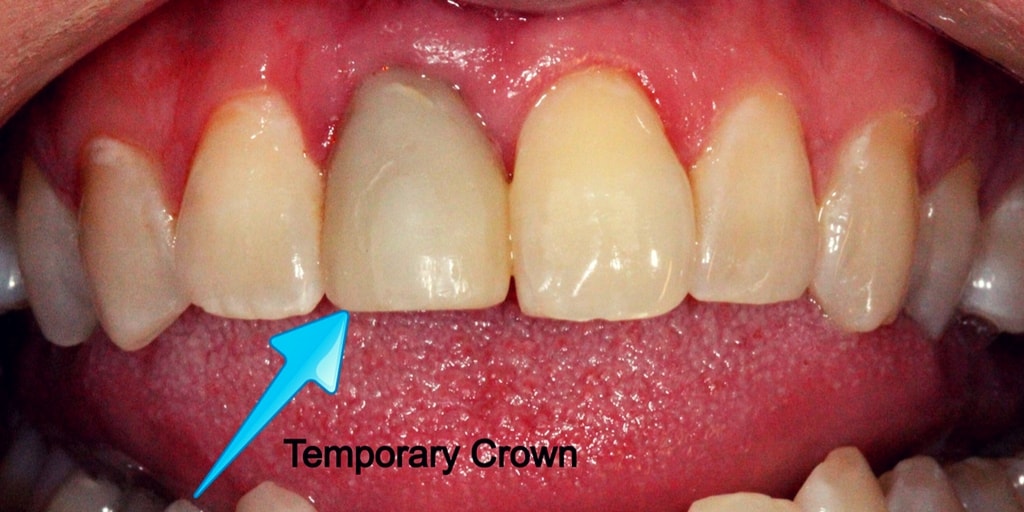 Things you need to know about temporary crowns