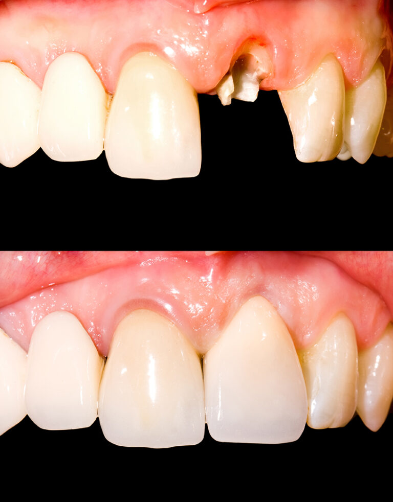 Taking care of temporary crowns 1 DENTIST IN CALIFORNIA 95035