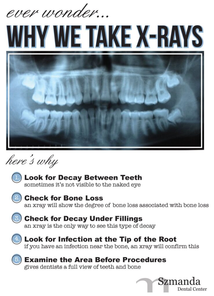 A dental radiograph is sometimes known as a dental x-ray. It is one of the dentist's most crucial diagnostic tools since it provides a clearer image of your teeth's condition than a simple oral examination. The Bitewing X-Ray Because they are a fantastic way to spot any decay between teeth or below the gumline, bitewing X-rays are extremely popular and frequently used for prophylactic purposes. Because patients must bite down on the X-ray film, the term "bitewing" was coined. These X-rays can be taken while the patient is sitting in the dentist chair. Precision X-Ray Bitewings reveal the majority of the tooth, but a periapical X-Ray is preferable if your dentist needs to see your complete tooth or jawbone. An image of the complete tooth, including a little portion of the tooth root, is captured by this kind of X-ray. The complete upper or lower row of teeth is often shown in one image on the X-ray. If your dentist suspects difficulties with the jawbone or damage to the tip of the tooth root, these kinds of X-rays could be taken. Occlusal X-Ray Occlusal X-rays are made to record what occurs inside the roof or floor of the mouth, allowing the dentist to see the whole development and positioning of the teeth. This may be used to identify supernumerary (additional) teeth that could harm good permanent teeth or to determine why teeth haven't yet erupted. Panoramic X-Ray Panorama x-rays are similar to panorama pictures. Instead than merely a "snapshot" of a few teeth, they display the entirety of the mouth. These images are acquired from the outside of the mouth as opposed to the inside, unlike regular dental x-rays. The patient does not move as an x-ray machine circles their head in an arc from one side to the other. The end result is a single, extended image that displays every tooth and jaw as well as the nasal passage and sinuses.
