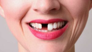 Benefits of wearing teeth retainers