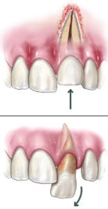 What is tooth trauma