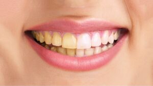 Ways to improve and whiten teeth
