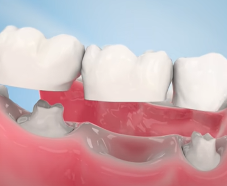 How long can dental bridges and dental crowns last?