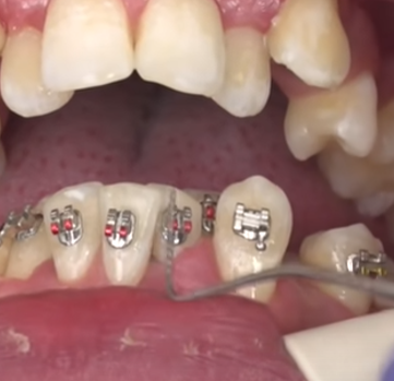 How to remove braces