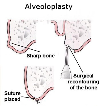 what is alveoplasty