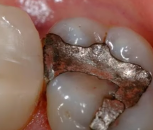 Why Are Amalgam Fillings Being Phased Out