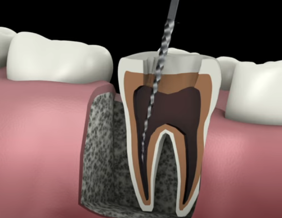 Does Root Canal Treatment Kill Your Tooth