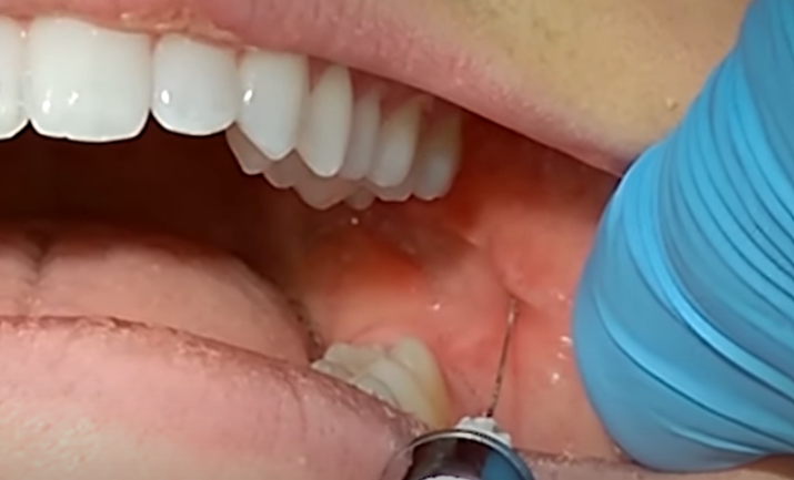 What is Buscal in Dental